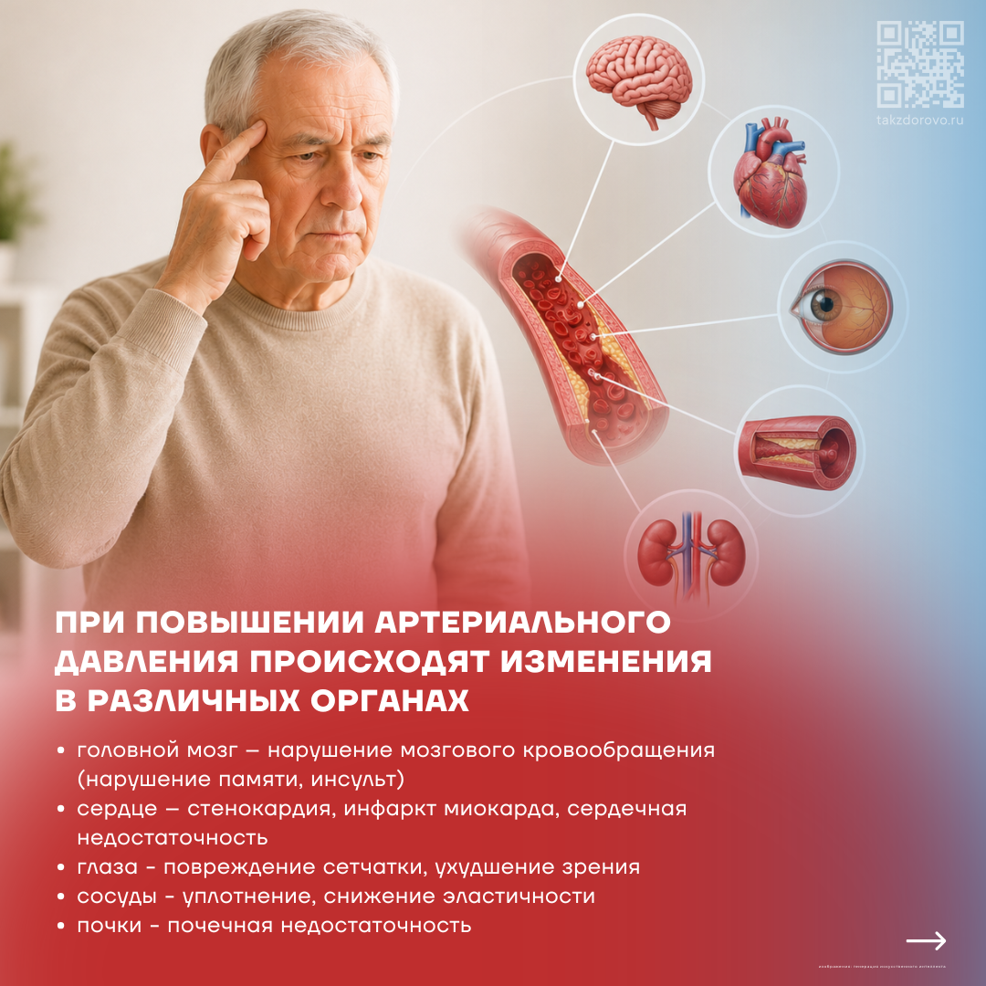 Артериальная гипертония 4